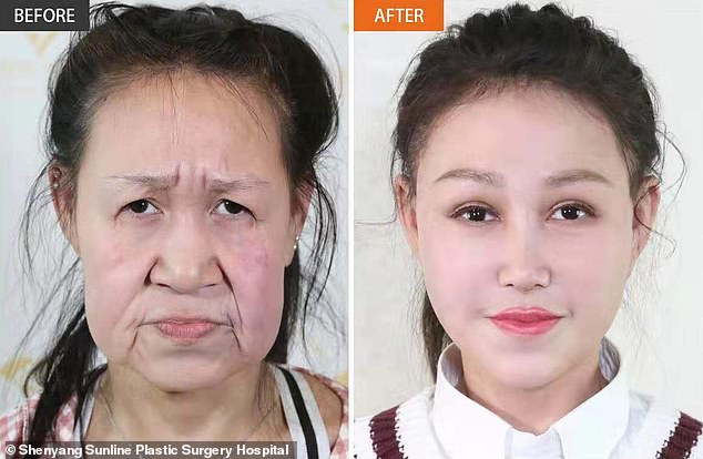 Una joven de 15 años que aparenta 60 por una enfermedad rara rejuvenece su cara gracias a la cirugía plástica