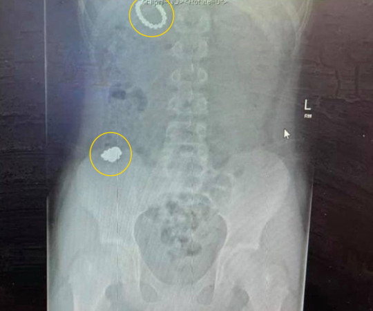 Subnormagneto: Un chaval casi muere después de tragarse 54 imanes para ver si se hacía magnético