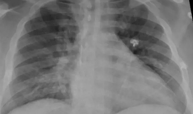 Un finolier que acaba de salir del hospital por una neumonía bilateral, nos cuenta su experiencia