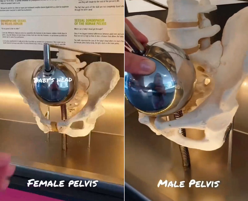 Las bolas de acero representan el tamaño de la cabeza de un recién nacido.