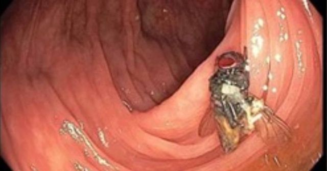 Encuentran una mosca viva en el colon de un paciente durante una prueba