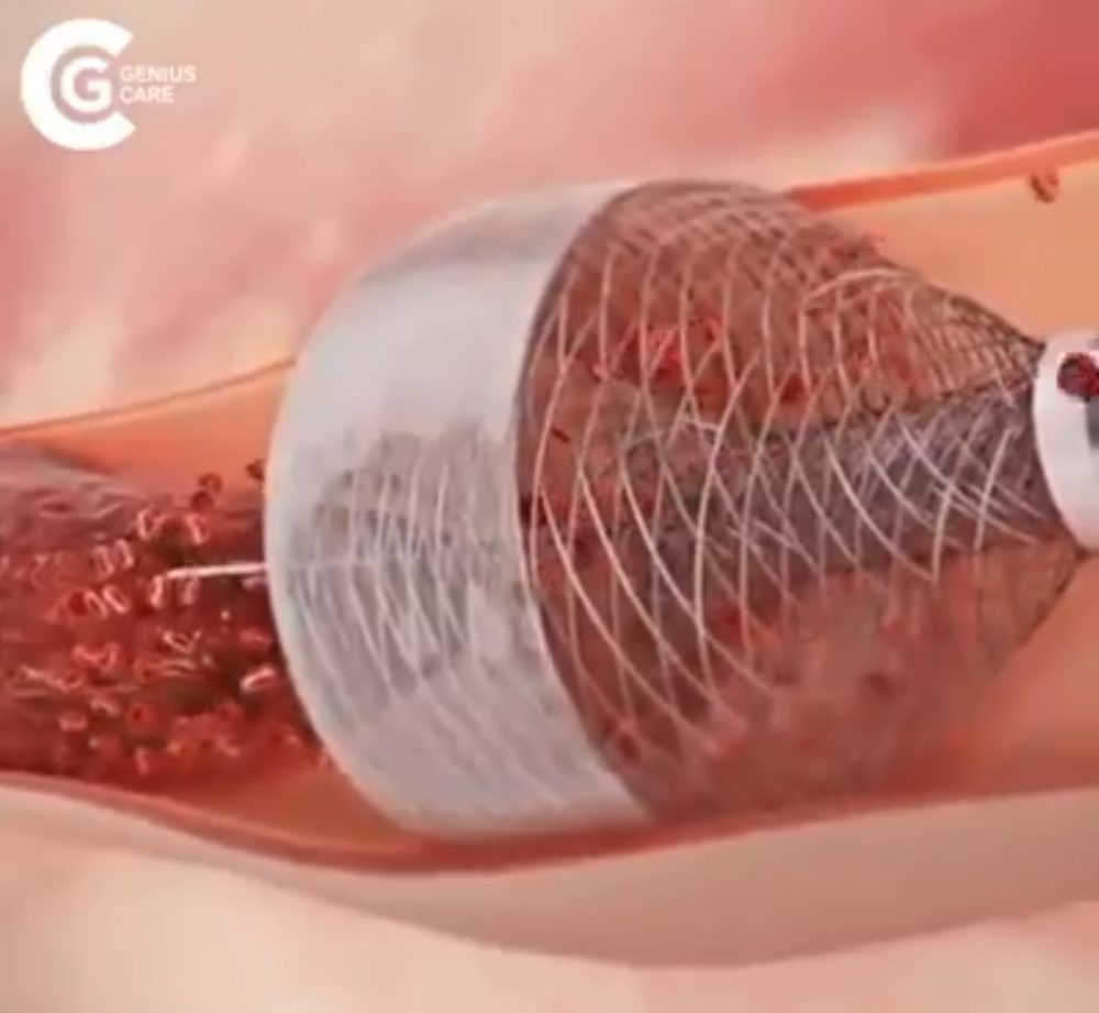 Esta novedosa técnica promete limpiarte las arterias como si fueran cañerías