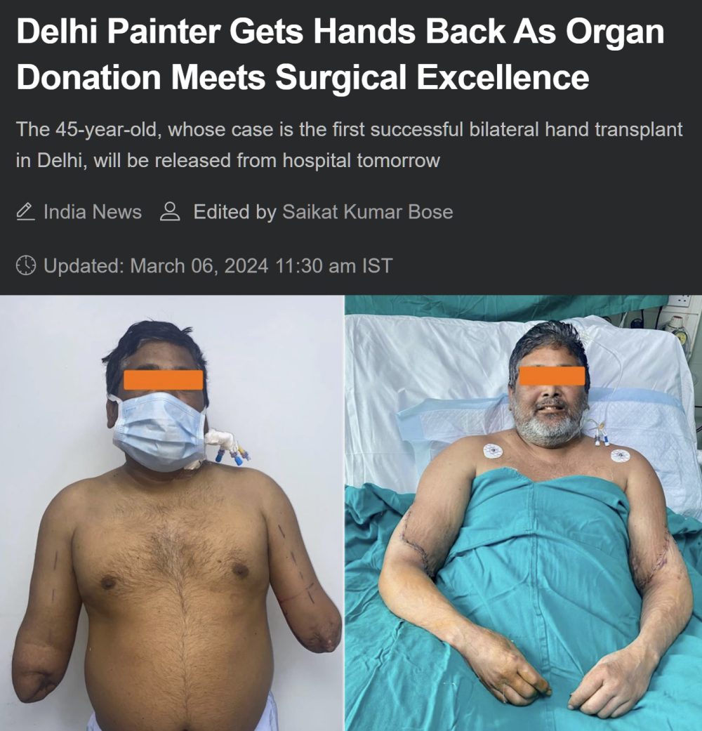 Pintor de Delhi recupera sus manos gracias a un donante