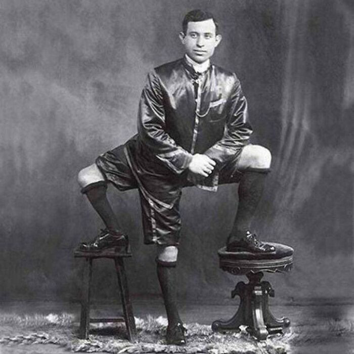 Este es Francesco Lentini, el hombre de tres piernas.