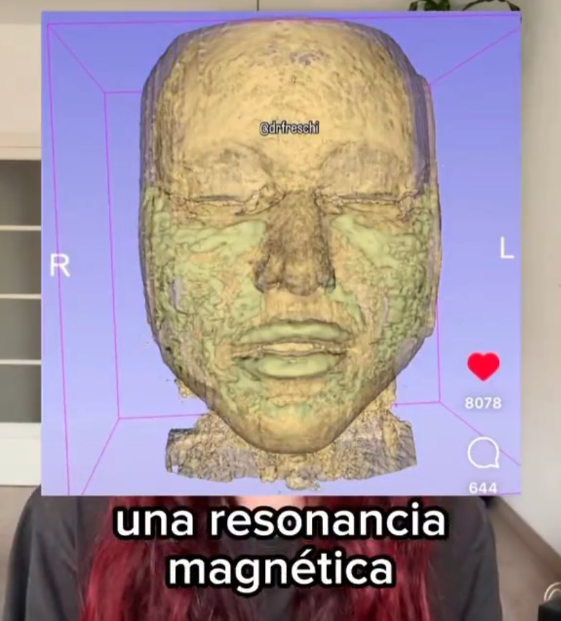 El ácido hialurónico que venden NO se reabsorbe