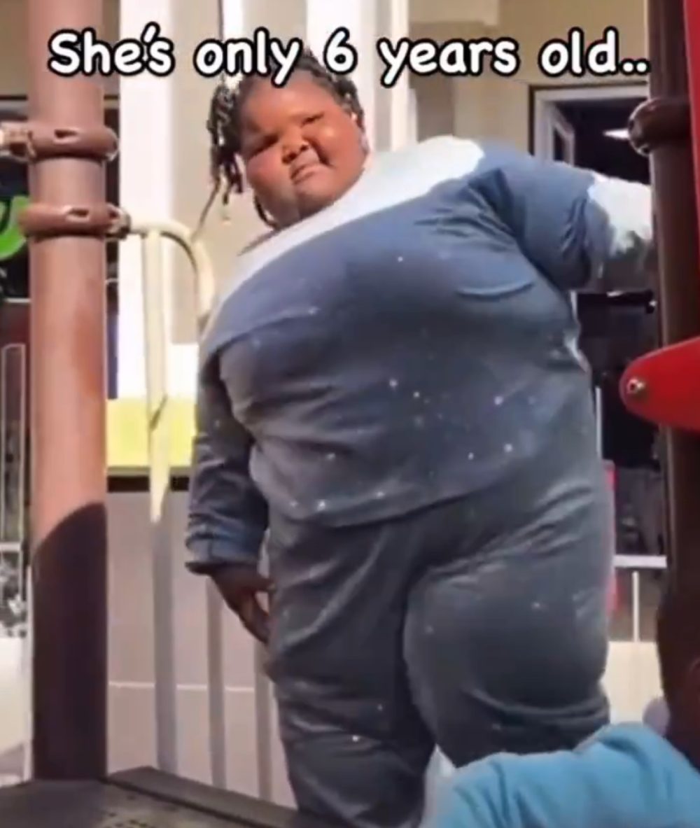 Una niña de 6 años con obesidad mórbida.