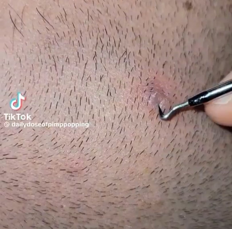 A este hombre se le ha enquistado un pelo de la barba, pero... ¿Desde cuándo lo tiene ahí?