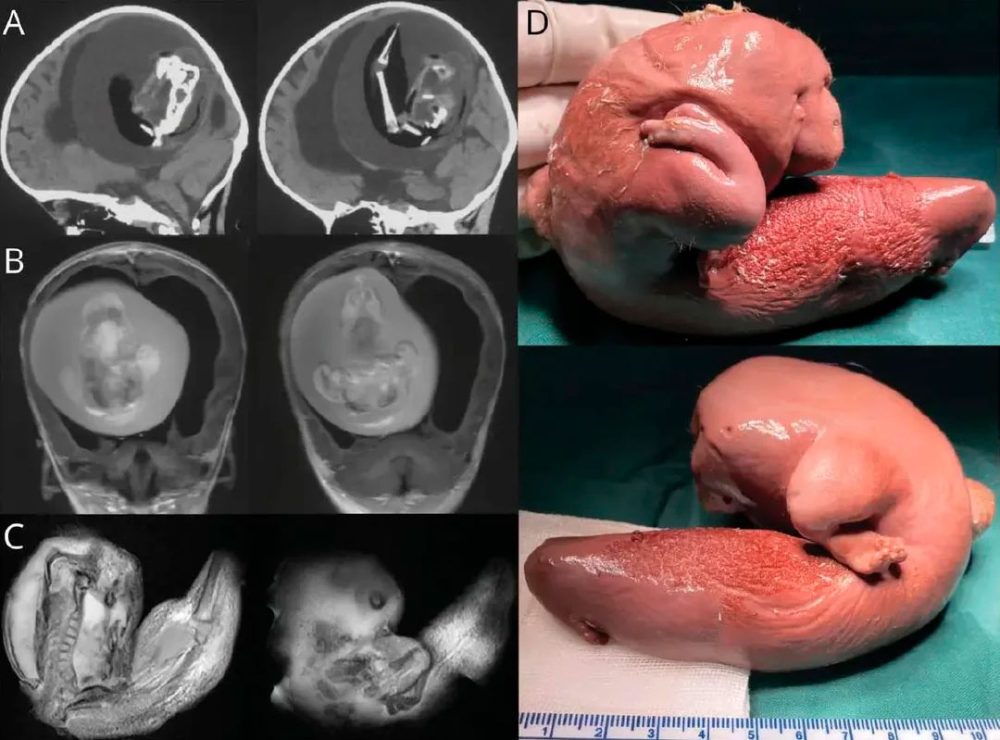 Un feto extraído del cerebro de una niña de 1 año (también conocido como Fetus in fetu)