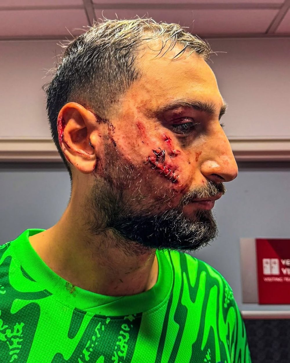 Así ha quedado la cara de Gianluigi Donnarumma después del terrorífico planchazo en la cara que sufrió ayer.