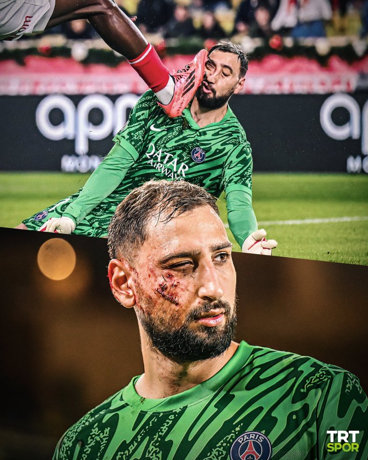 Así ha quedado la cara de Gianluigi Donnarumma después del terrorífico planchazo en la cara que sufrió ayer.