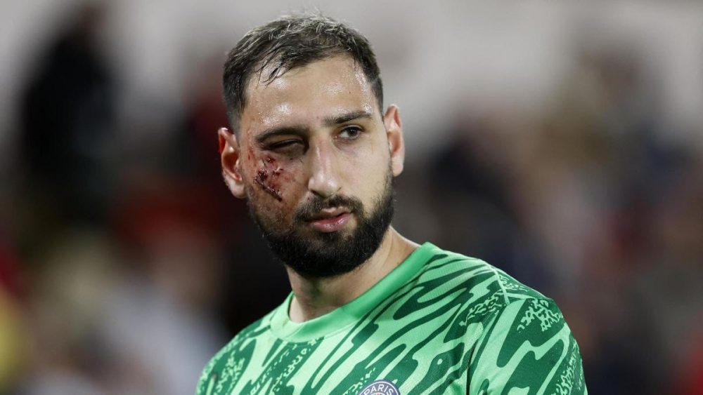 Así ha quedado la cara de Gianluigi Donnarumma después del terrorífico planchazo en la cara que sufrió ayer.