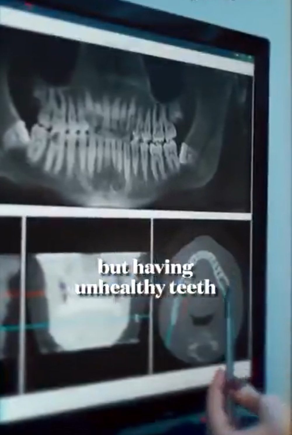 Científicos japoneses han desarrollado un fármaco que permite que los dientes vuelvan a salir.