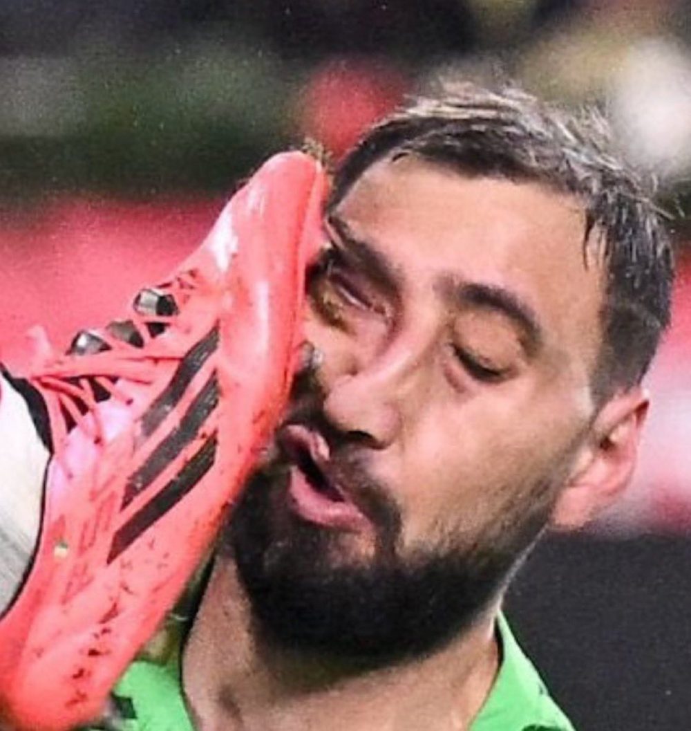 Así ha quedado la cara de Gianluigi Donnarumma después del terrorífico planchazo en la cara que sufrió ayer.