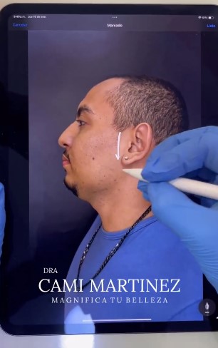 "Operación de masculinización facial"