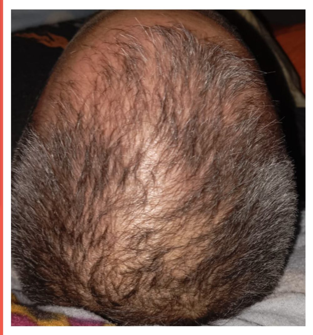 "Me estoy EMPEZANDO a quedar calvo" dice...