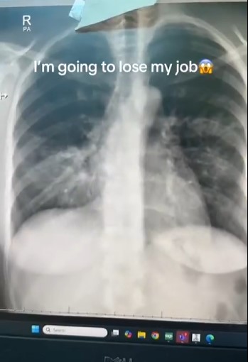 Un doctor queda impresionado al ver cómo la IA es capaz de diagnosticar una neumonía a partir de una radiografía. Habilidad que a él le ha costado 20 años de carrera adquirir.