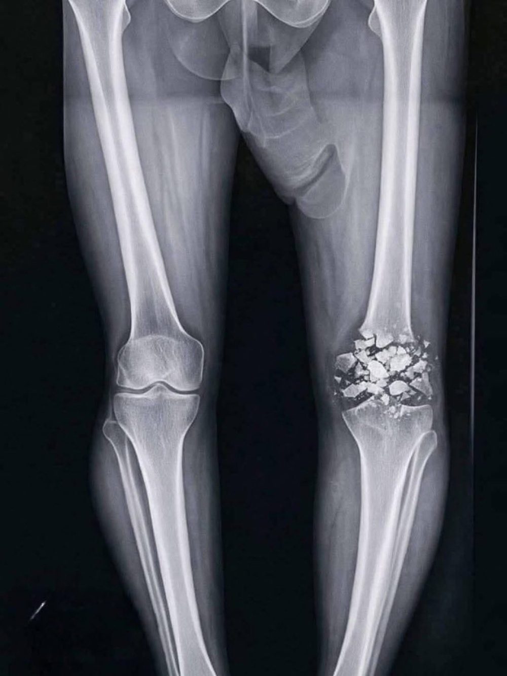 Espeluznante cómo quedó la rodilla de este futbolista tras la patada de un rival.