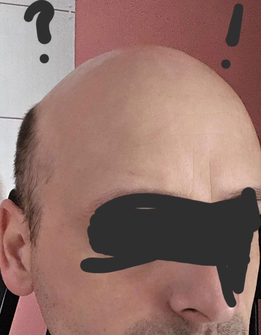 "Soy 99% calvo y aun así he pillado piojos"