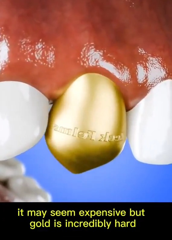 La razón por la que ponerse implantes de oro no es buena idea.