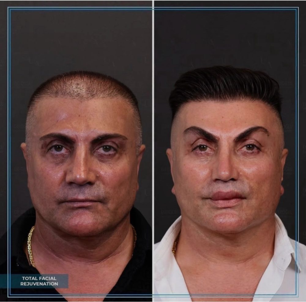 "Total facial rejuvenation"