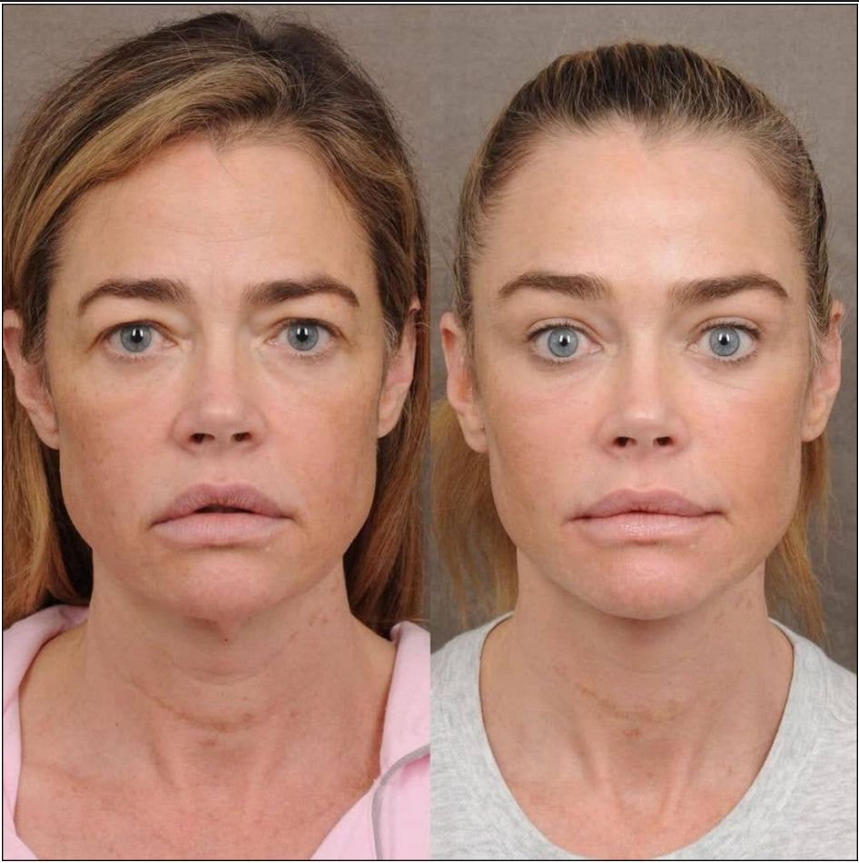 Denise Richards (55) se restaura la cara.