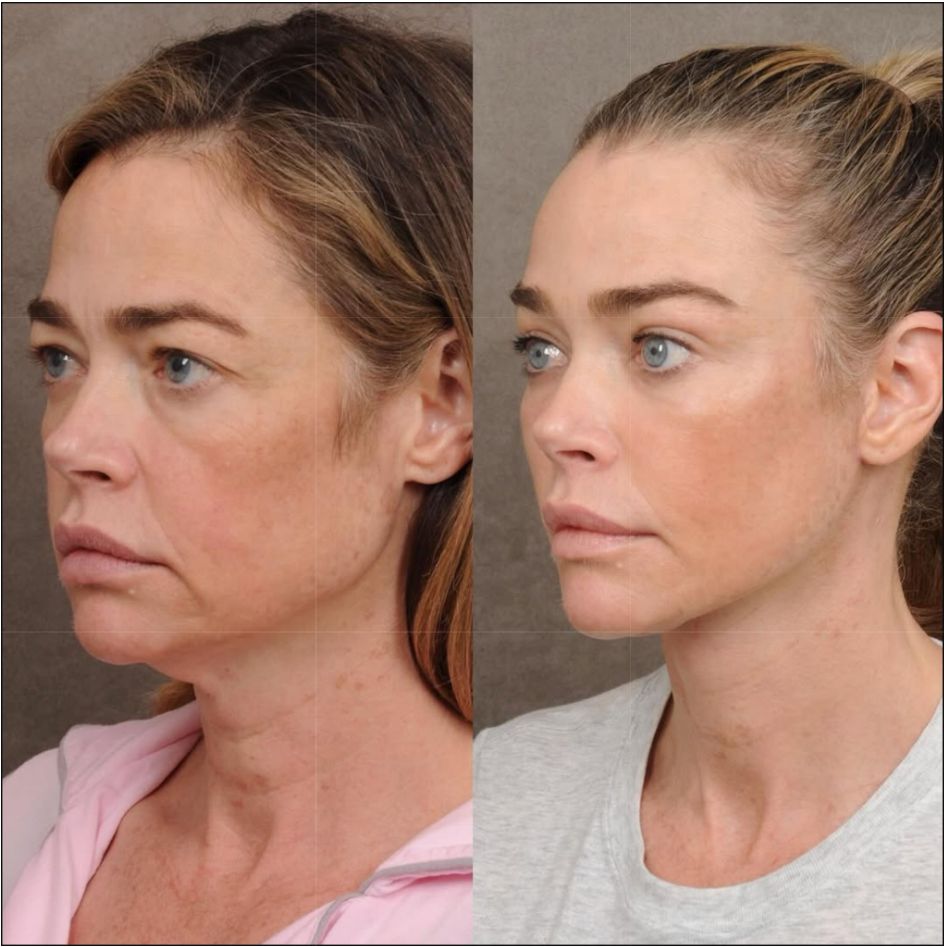 Denise Richards (55) se restaura la cara.
