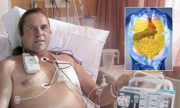 En 2011, Steven McCormack cayó sobre la boquilla de una manguera de aire a alta presión en Nueva Zelanda.